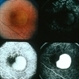 Fibrovascular  PED Fibrovascular  PED
